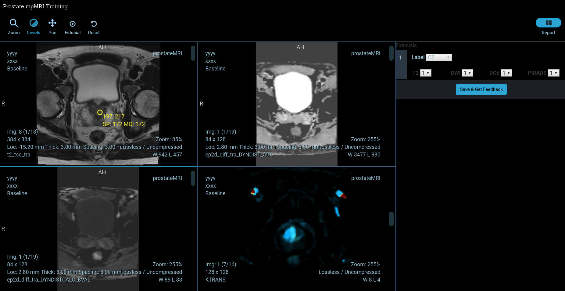 prostate mpmri web viewer