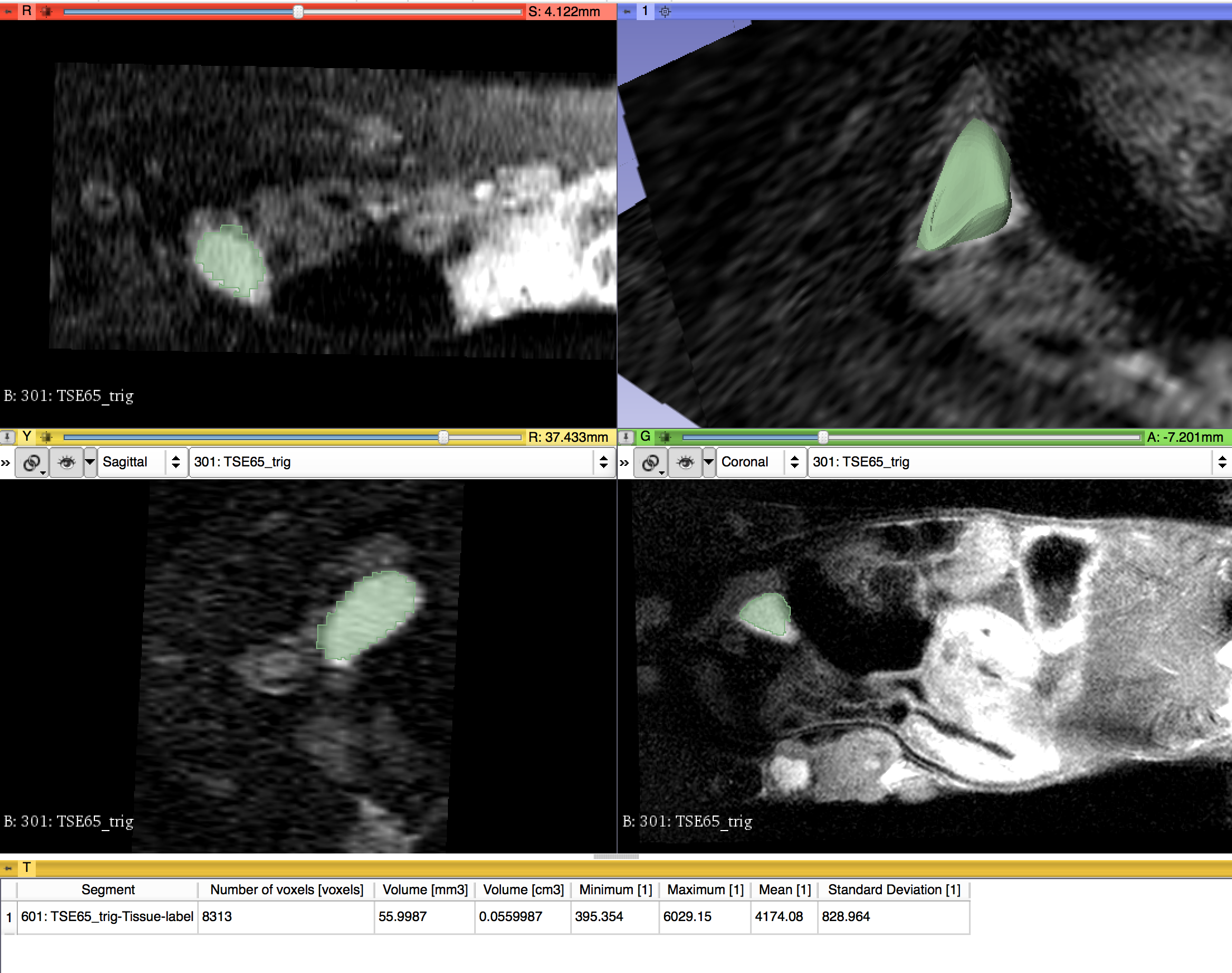 Neuroendocrine Liver lesion as DICOM segmentation object