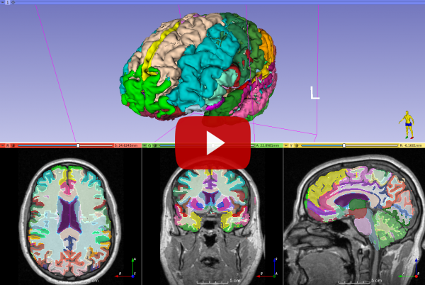 Brain Parcellation on 3D Slicer